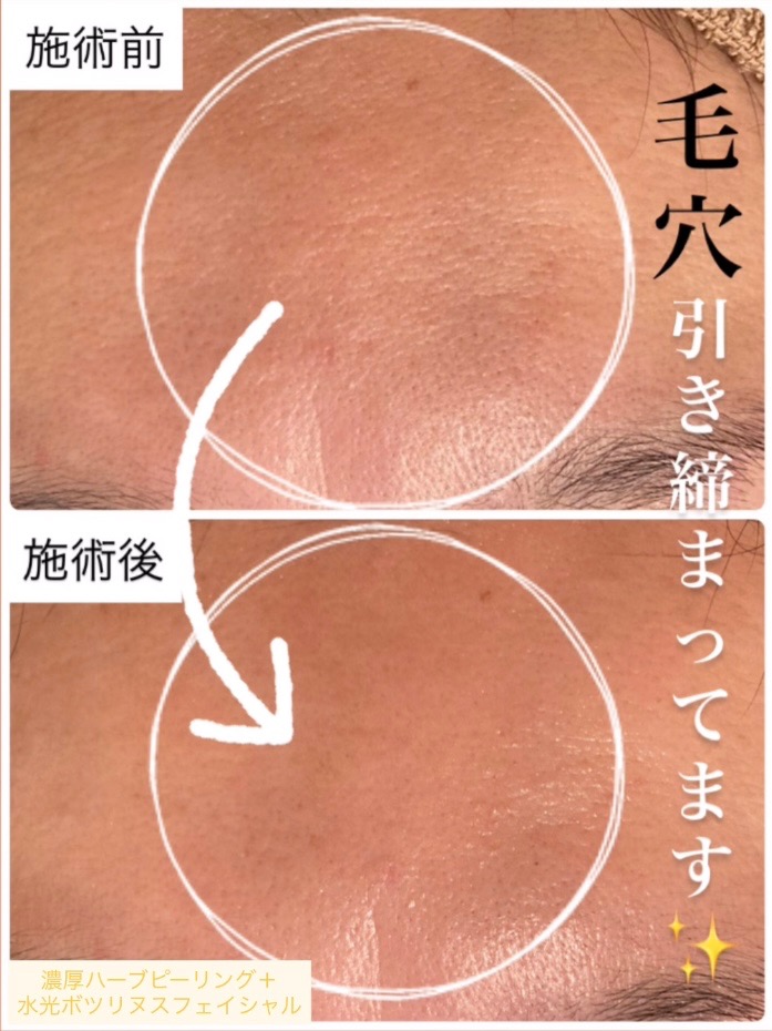 1回の施術で毛穴引き締まってます✨