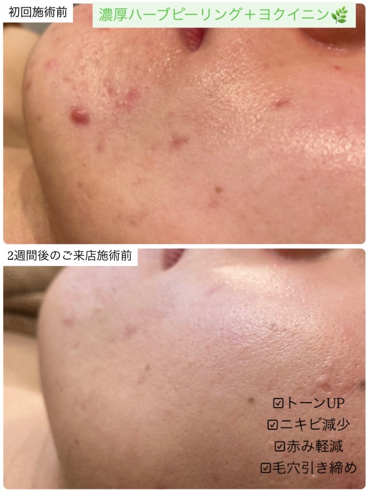 ニキビや赤み減ってます(^^)