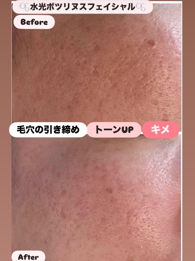 毛穴の引き締め/クスミ改善✨