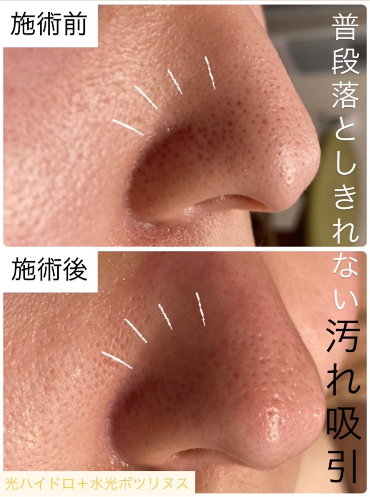 皮脂や汚れをしっかり吸引🌀