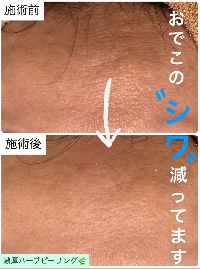 1回の施術でも効果実感！！✨