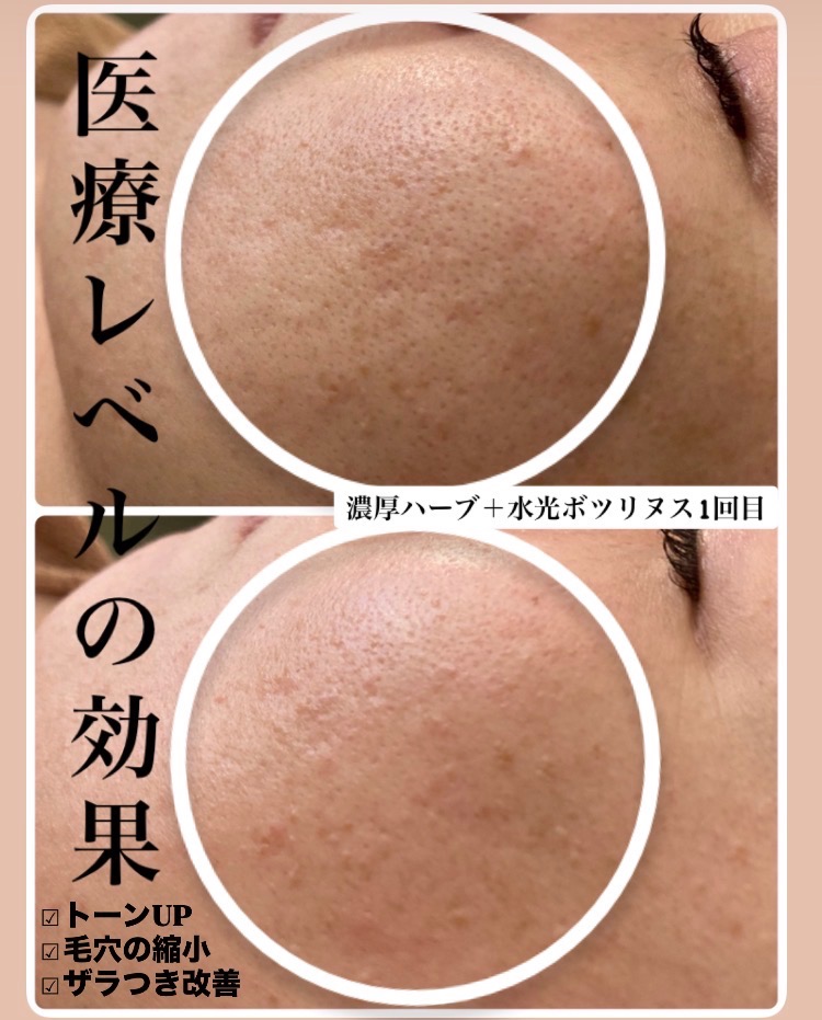 肌トーンUP‼️毛穴の縮小も効果絶大◎