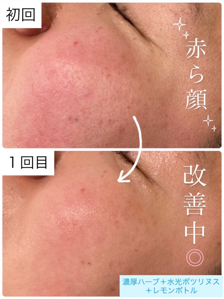 赤ら顔にも効果あり◎