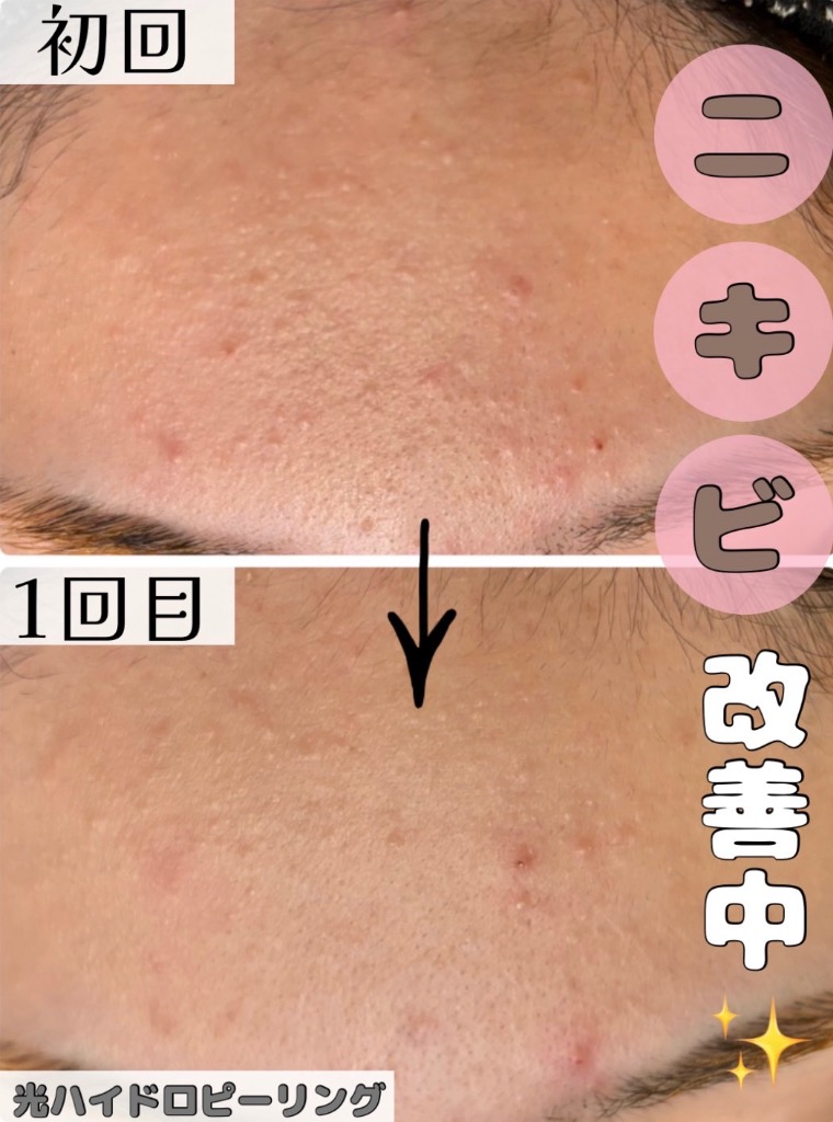 施術1回目の効果でニキビ減ってます✨