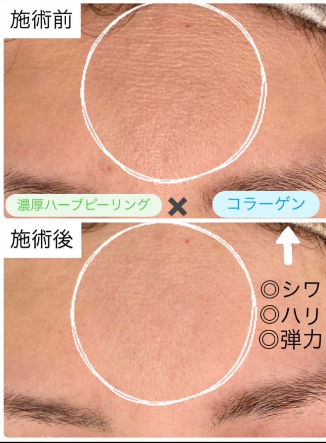 １回の施術でもシワが薄くなってます✨