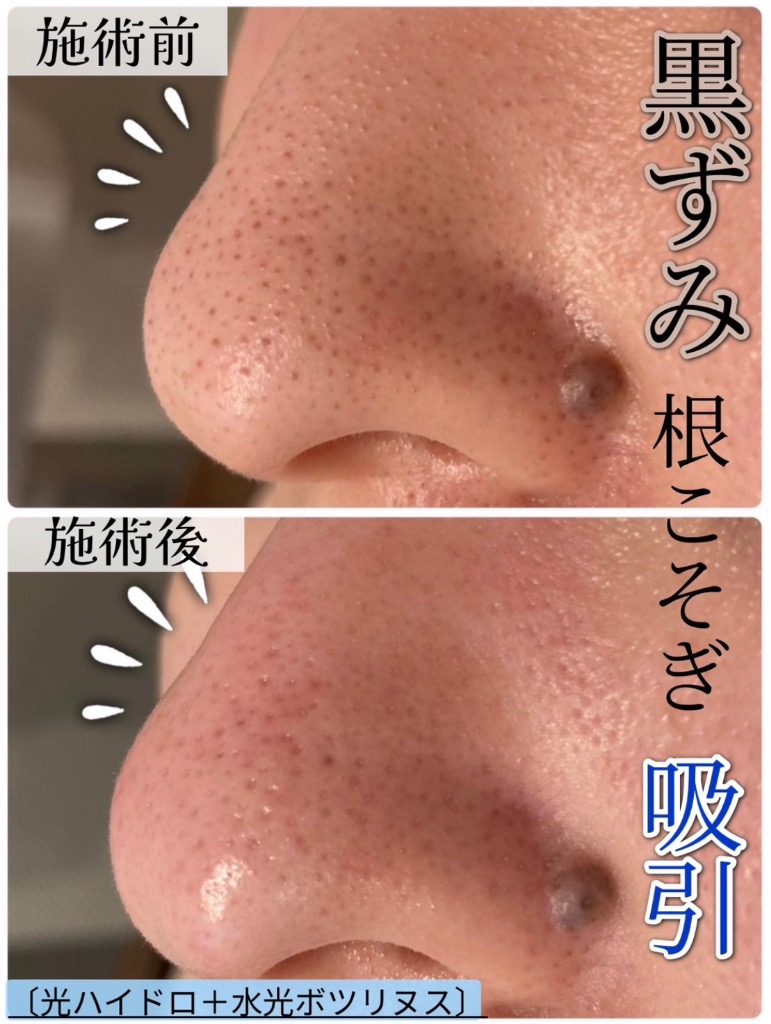 皮脂や汚れしっかり吸引◎