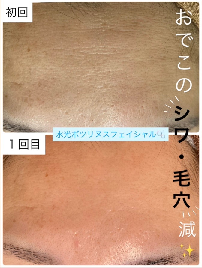おでこのシワ・毛穴が激減！✨