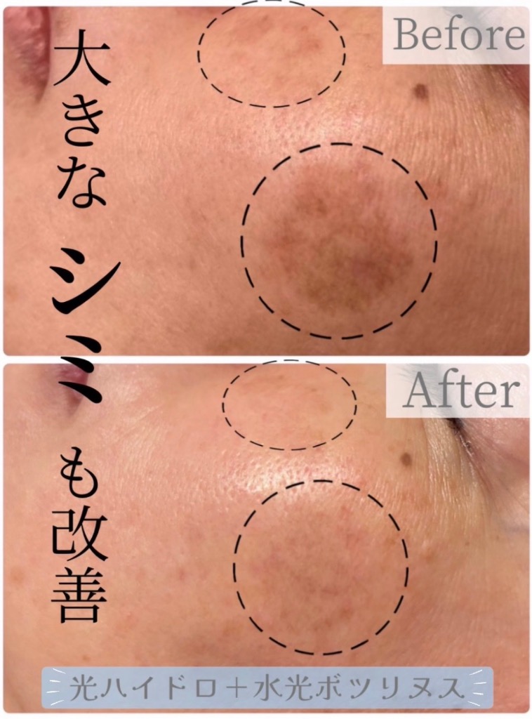 長年悩んでいたシミも改善◎