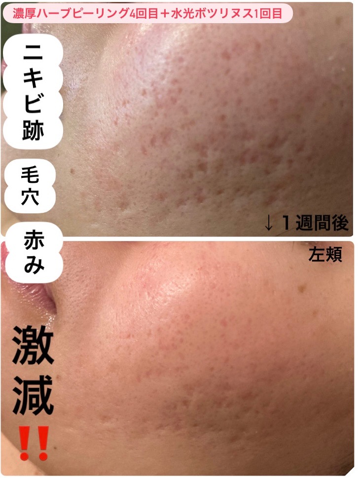 ニキビ跡＋赤み激減！