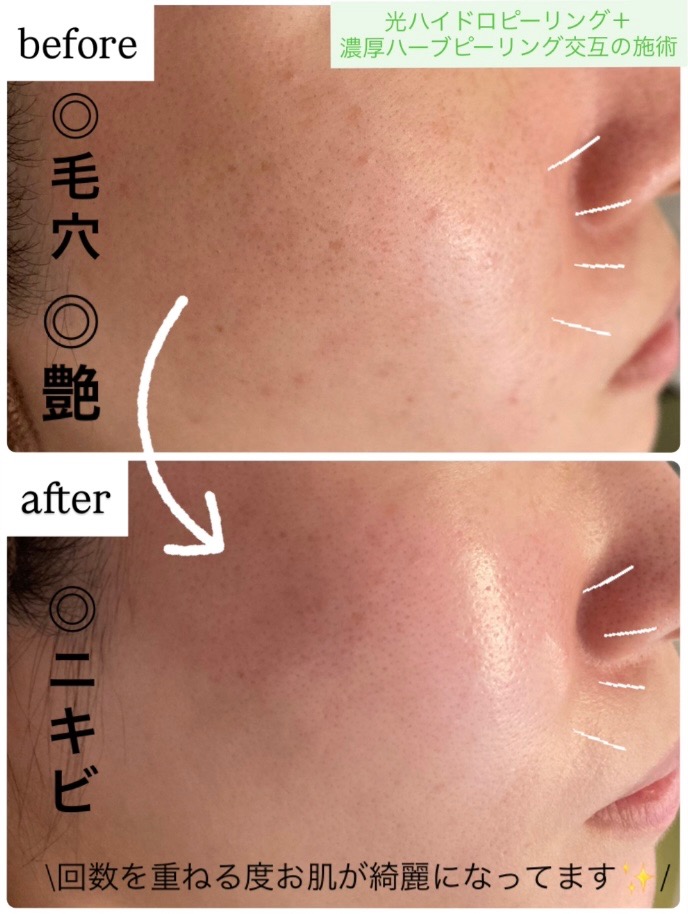 回数を重ねる度お肌が綺麗になってます✨