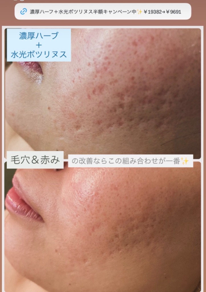 大きめの毛穴/赤みの改善なら 濃厚ハーブと水光ボツリヌスの 組み合わせが◎
