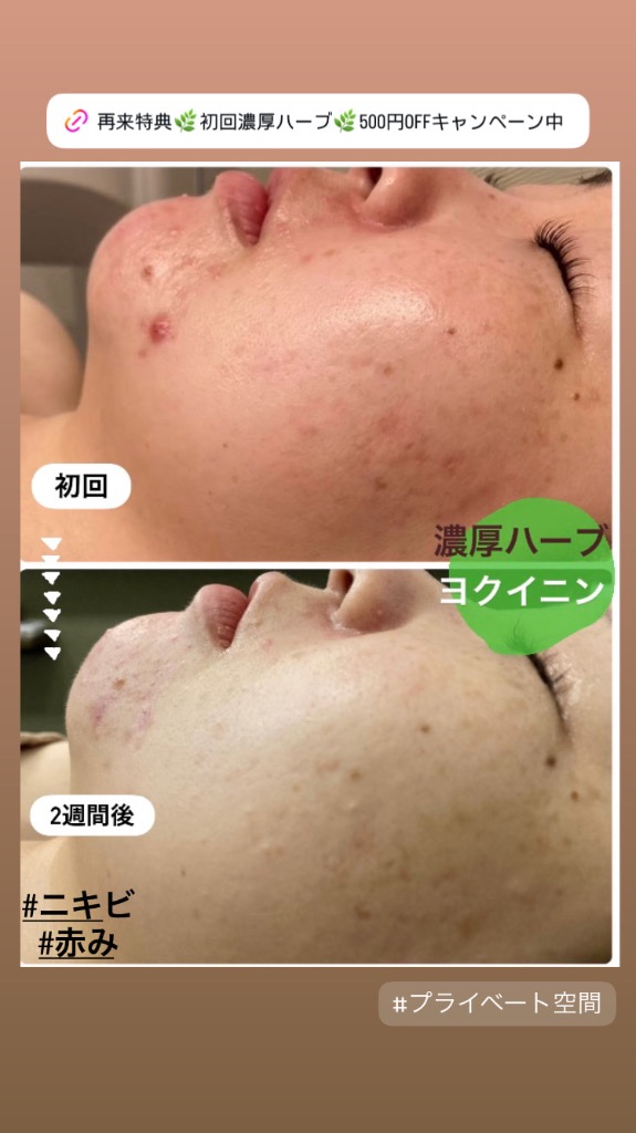 ニキビが枯れて赤みも軽減✨