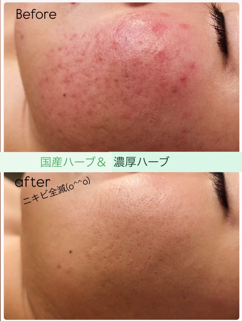 赤み/ニキビが0になりました(^^)