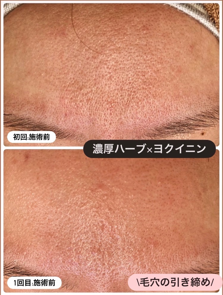 どちらも施術前の状態です(^O^)