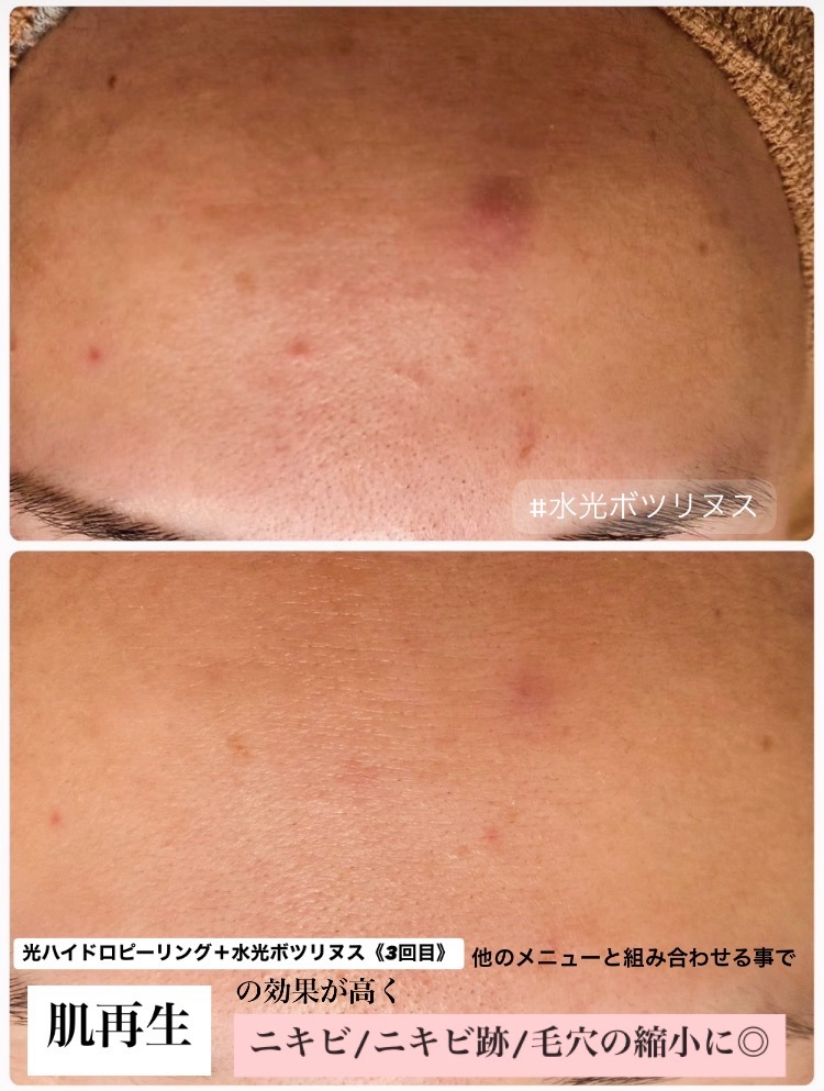 光ハイドロ＋水光ボツリヌス
