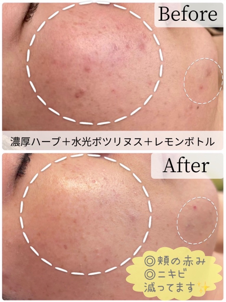 しつこいニキビ跡も改善◎