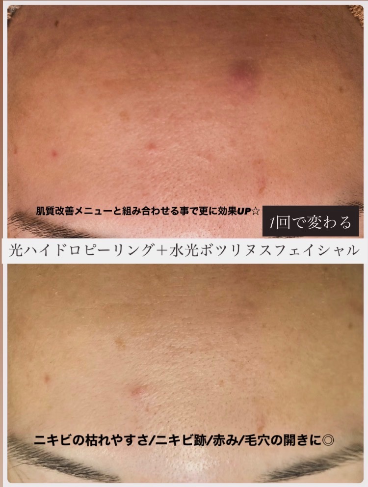 肌質改善と水光ボツリヌスの組み合わせがおすすめ◎