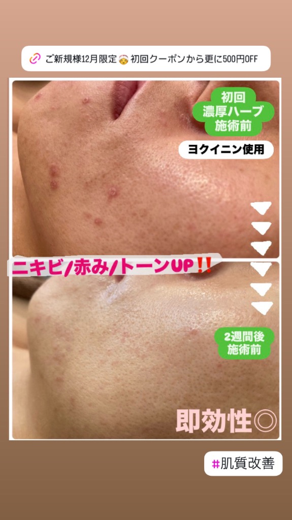 今だけ初回クーポンから更に500円OFF！