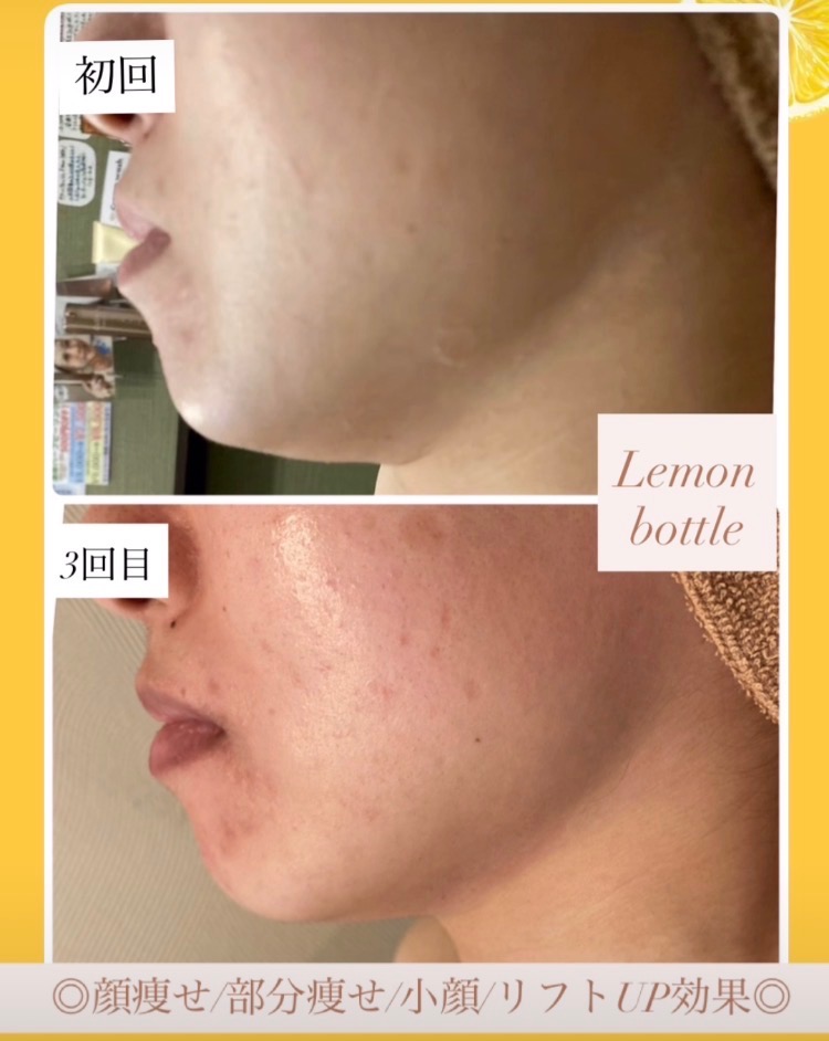 3回目の効果でこんなにフェイスラインがシュッとしました✨