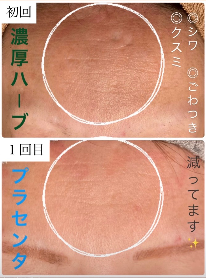 １回の施術効果で✨