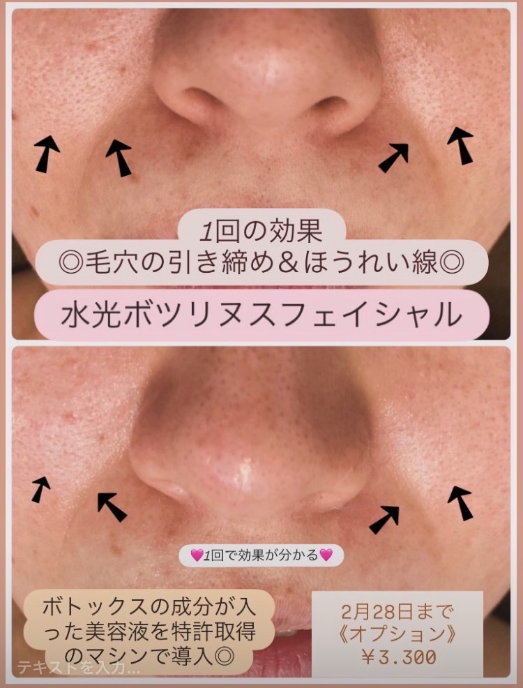 施術前後の効果✨ほうれい線と毛穴の開き
