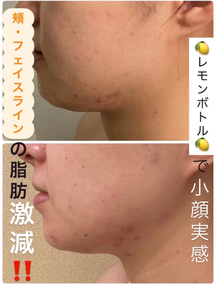 頬もフェイスラインもスッキリ！