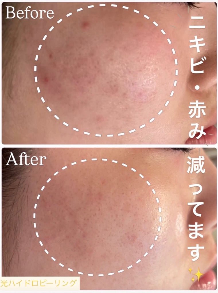 ニキビができにくいお肌になります🌼