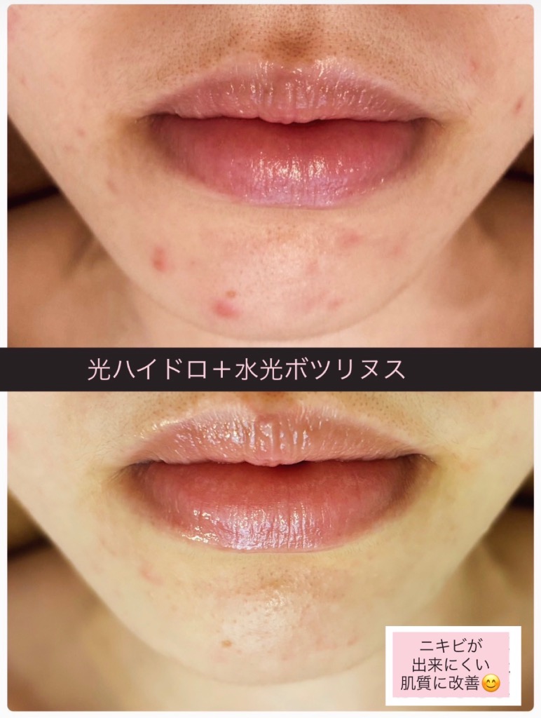 ニキビ肌改善できます😍