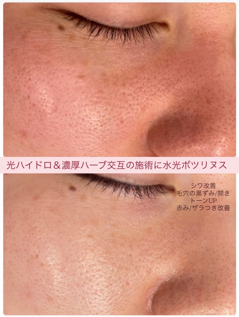 美肌に改善中◎