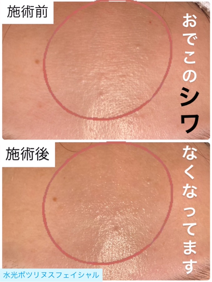 シワにも効果があります◎