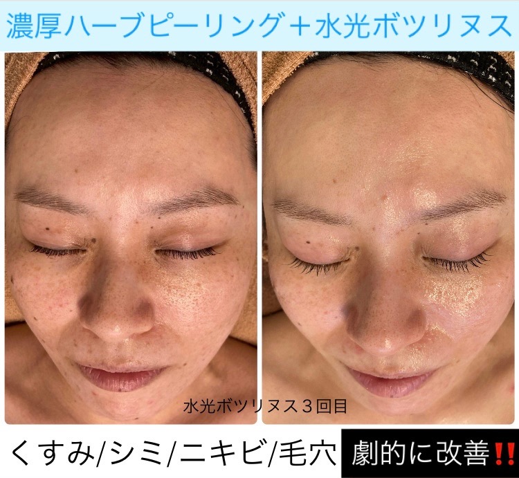 くすみも毛穴も激減！