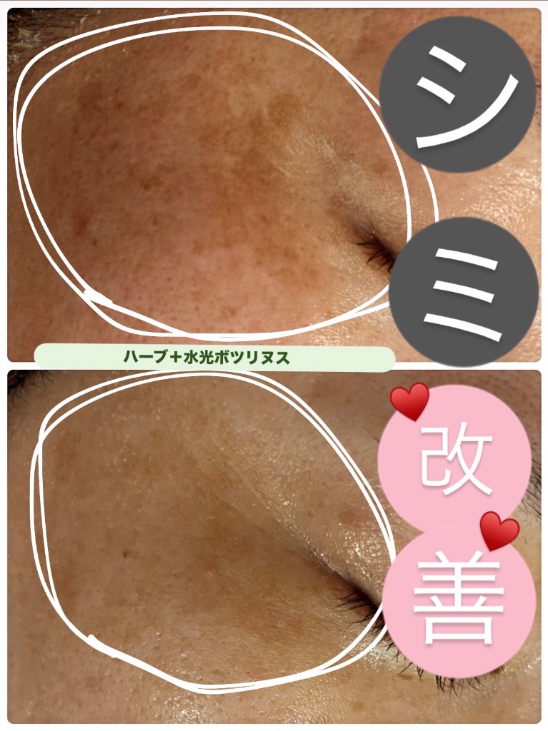 日本人の肌に合ったハーブで早い肌質改善へ♪