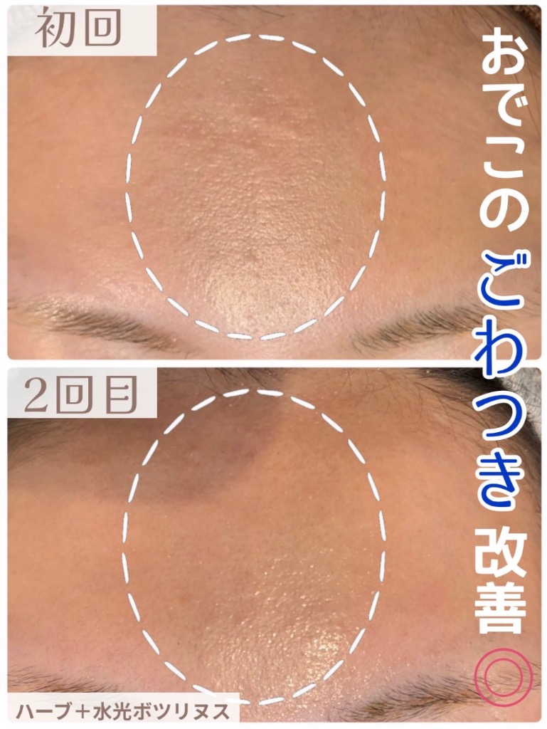 古い角質・ターンオーバーの乱れをアプローチ✨