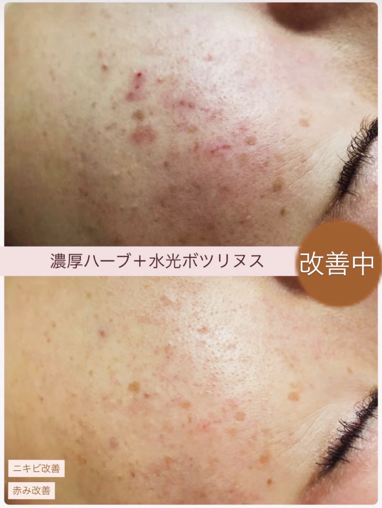 新しいニキビも今では0！((o(^∇^)o))