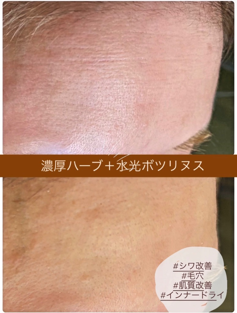 しわ/毛穴の開き/インナードライが改善されました◎