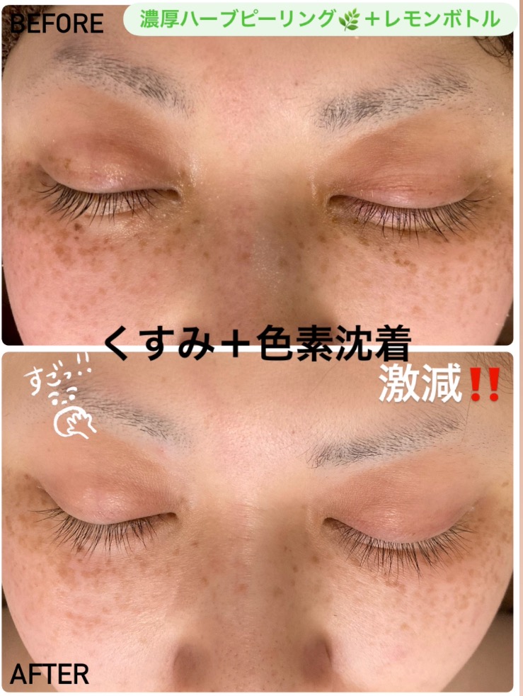 くすみも色素沈着も激減！