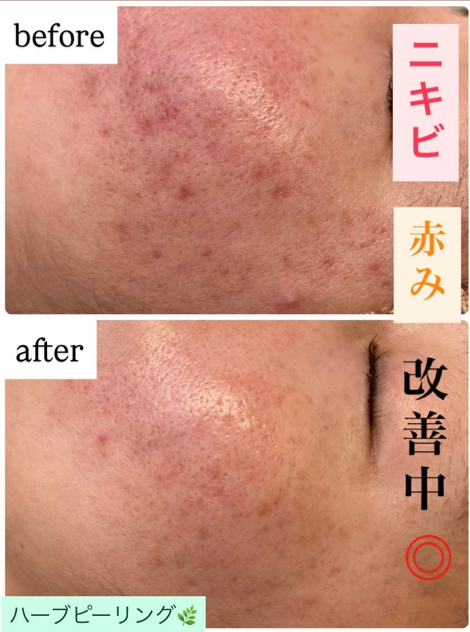 しつこい赤み・ニキビも改善✨