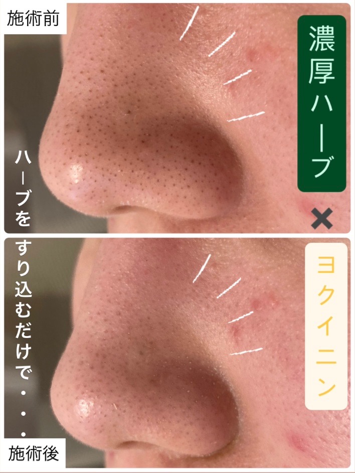 ハーブをすり込むだけで...