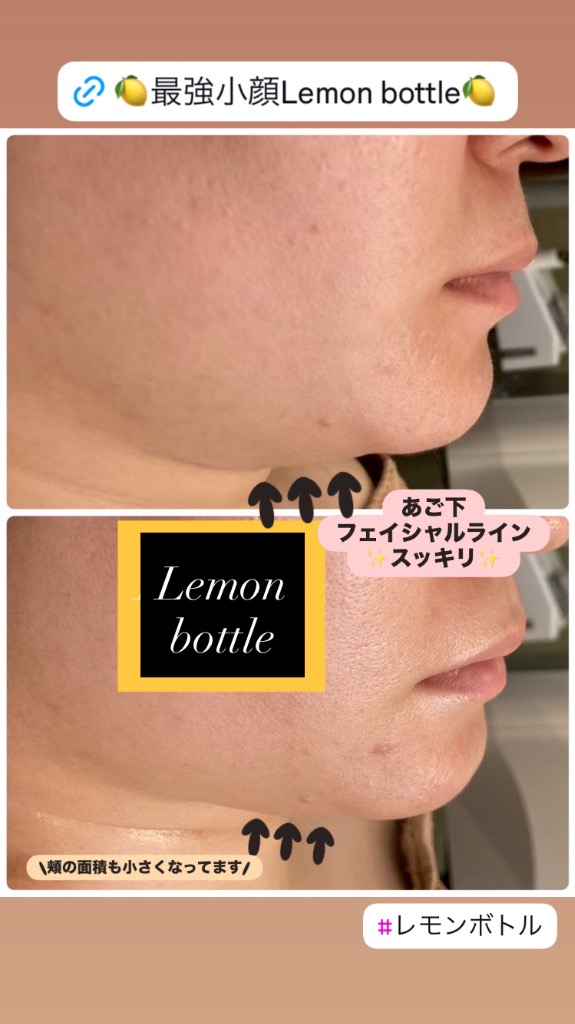 あご下フェイスラインスッキリ✨