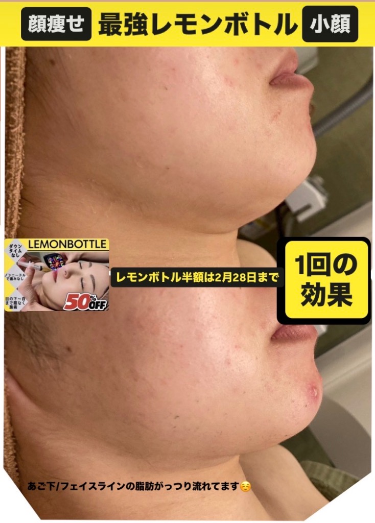 一気にあご下とフェイスラインの脂肪が流れました◎