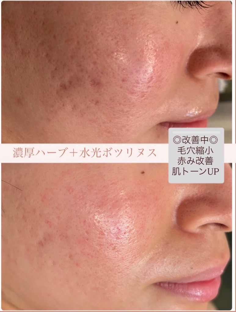 大きめの凹凸毛穴の方におすすめな組み合わせです◎