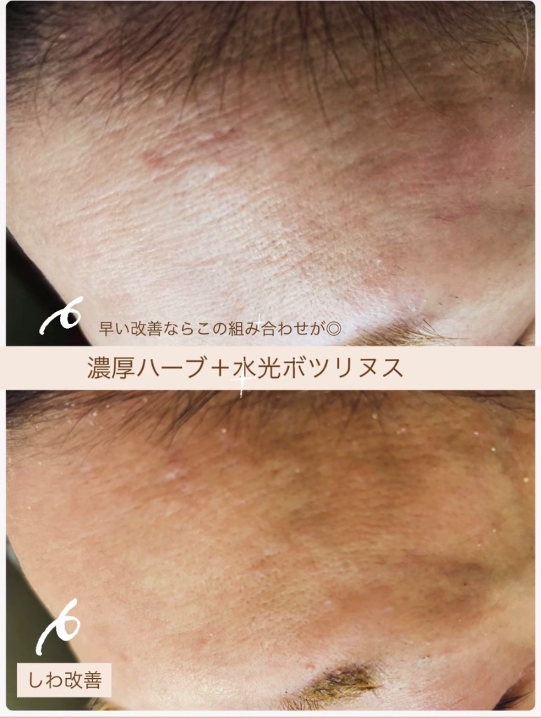 施術を重ねる度におでこのシワが薄くなられてます(^O^)