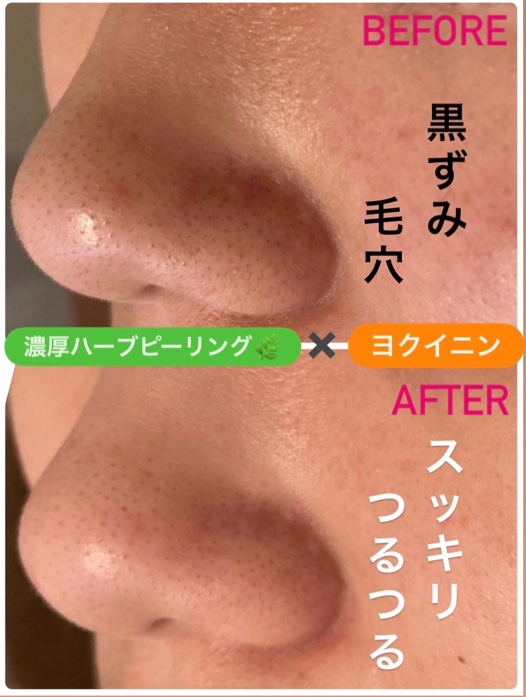 黒ずみ減ってます(^^)