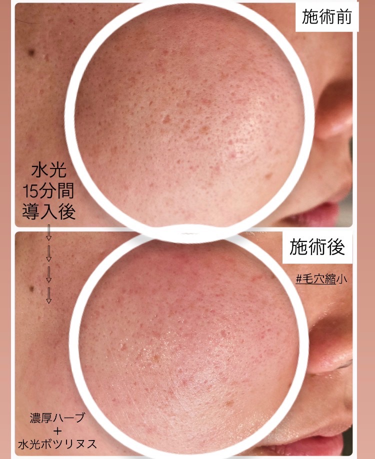 濃厚ハーブ＋水光ボツリヌス